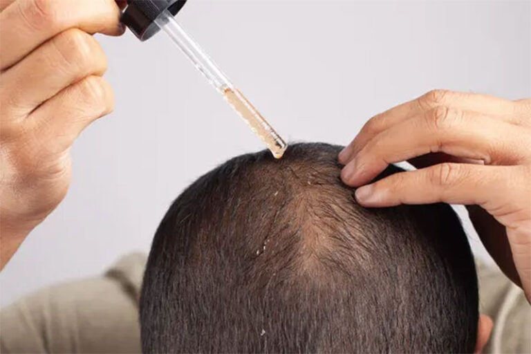 Minoxidil y los efectos contra la caída de cabello