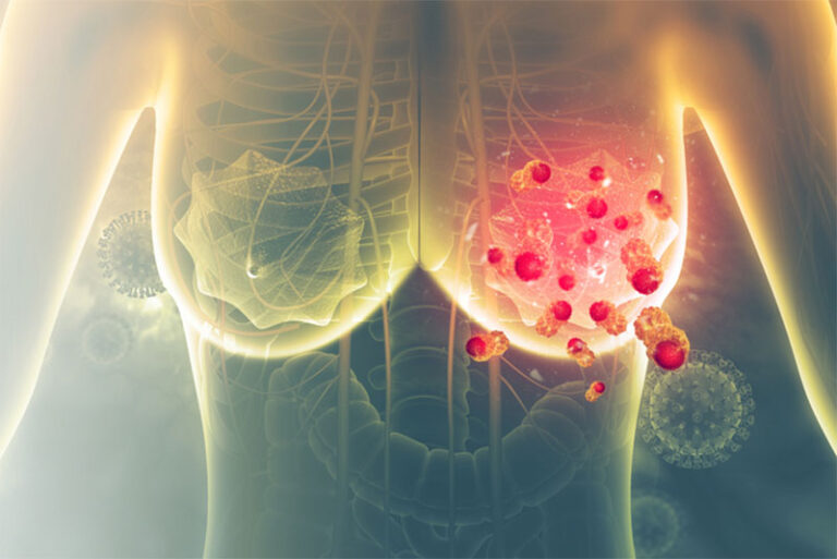 La alimentación es clave para evitar el cáncer de mama