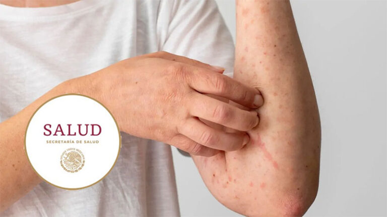 Llega a 31 los muertos por causa del sarampión